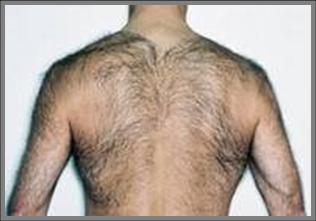 הסרת שיער לגברים בגב - לפני