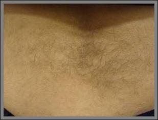 הסרת שיער לגברים בגב תחתון - לפני